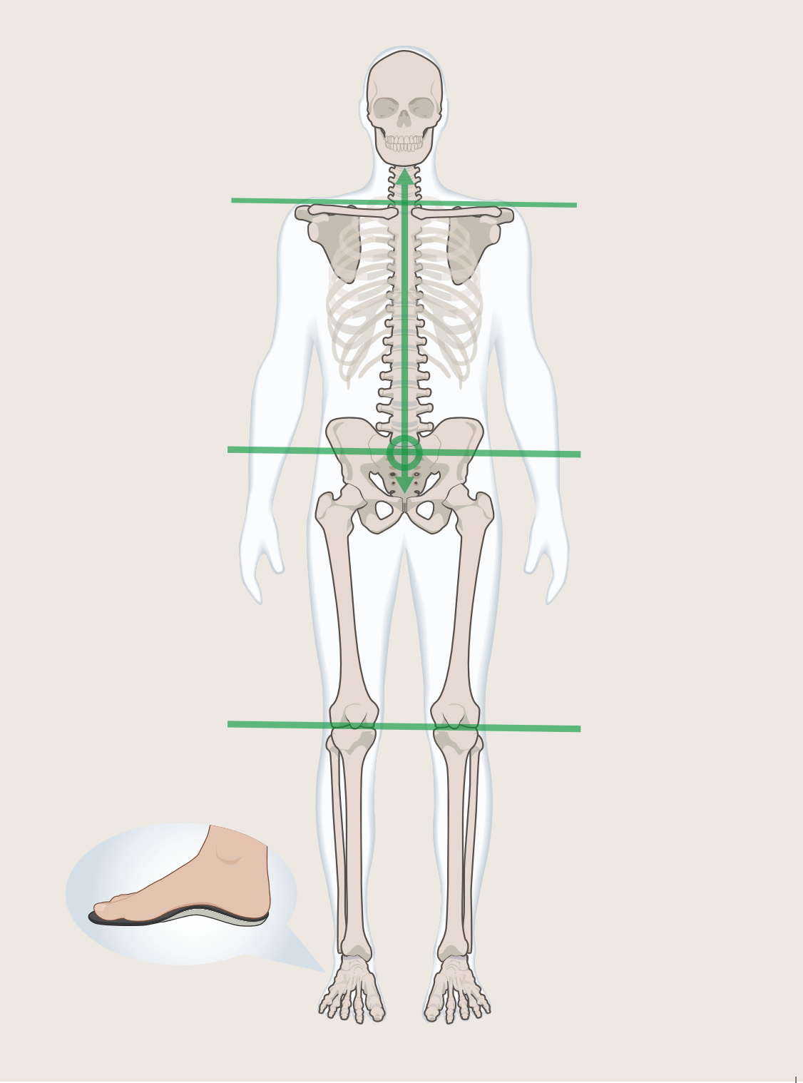 Figure diagram showing realigned posture with arches supported