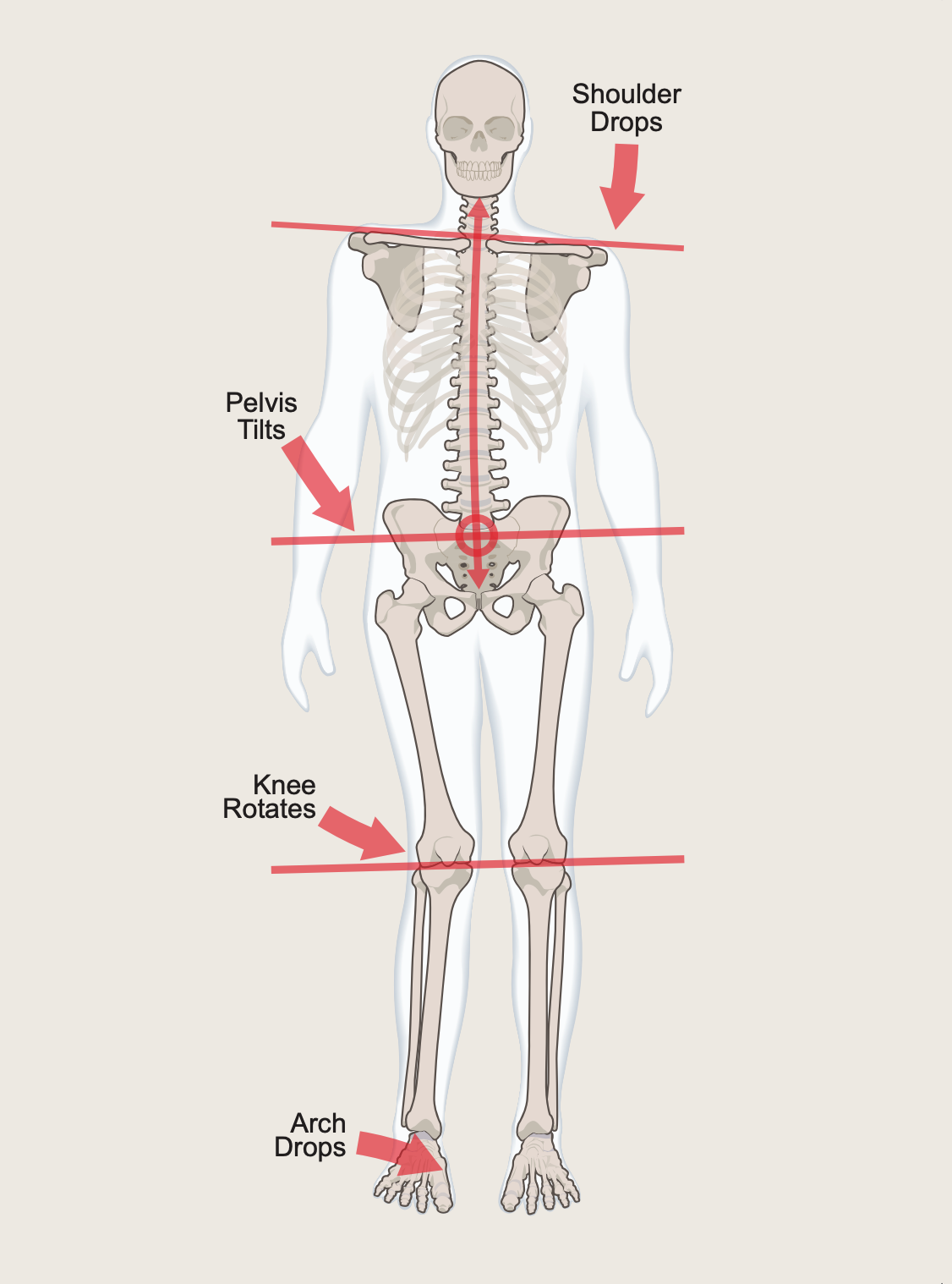 Skeleton diagram showing how dropped arches cause knee rotation, pelvis tilt and shoulder drop