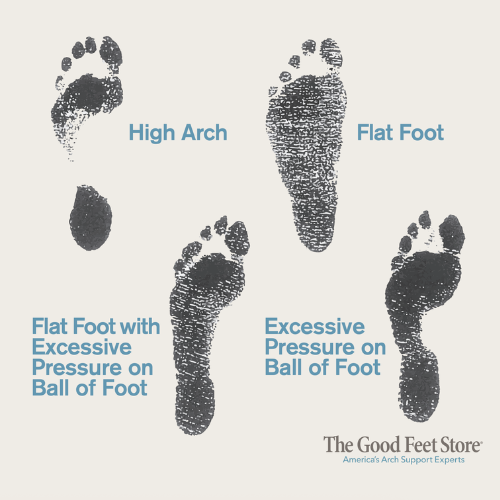 Comparison of high arch, flat foot, flat foot with ball-of-foot pressure, and excessive ball-of-foot pressure footprints